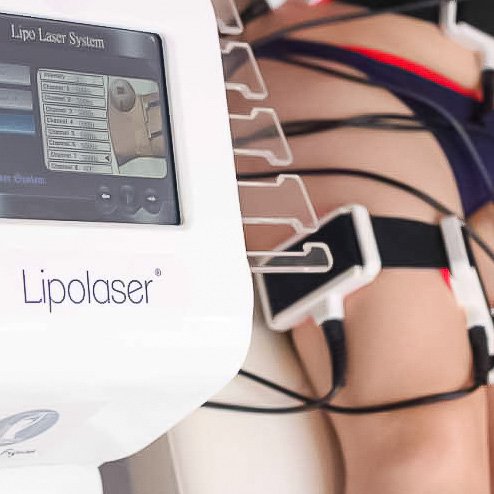 Lipolaser
